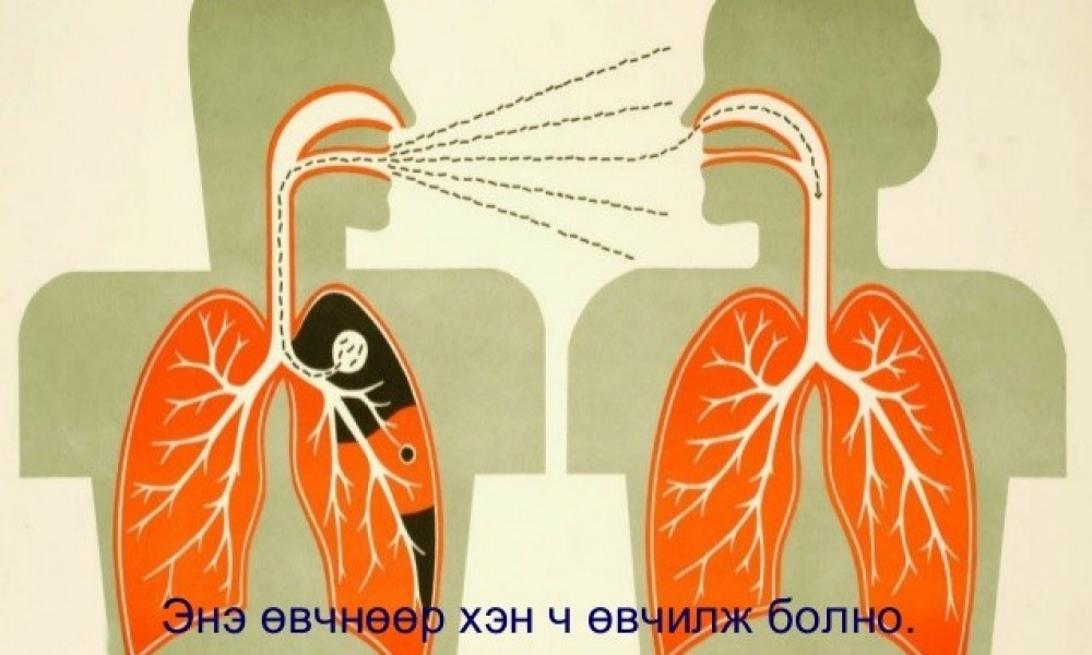 Сүрьеэ өвчинтэй тэмцэхэд төрийн бодлого эрх зүйн орчин хангалтгүй байна
