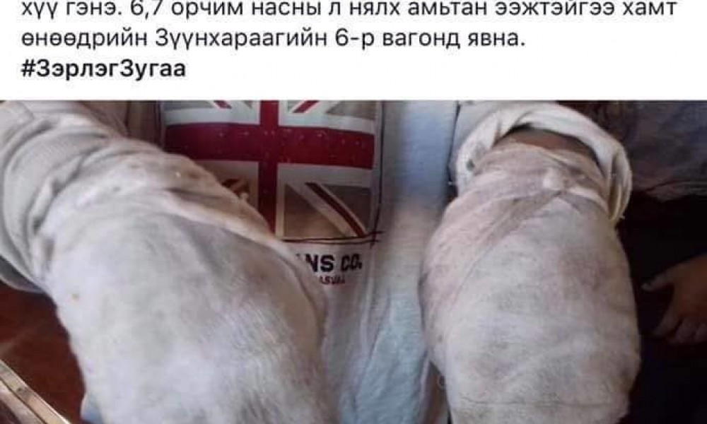 Зургаан настай хүүг ахдаа туслахаар гар чийдэн барьж яваад гараа хайруулсан гэлээ
